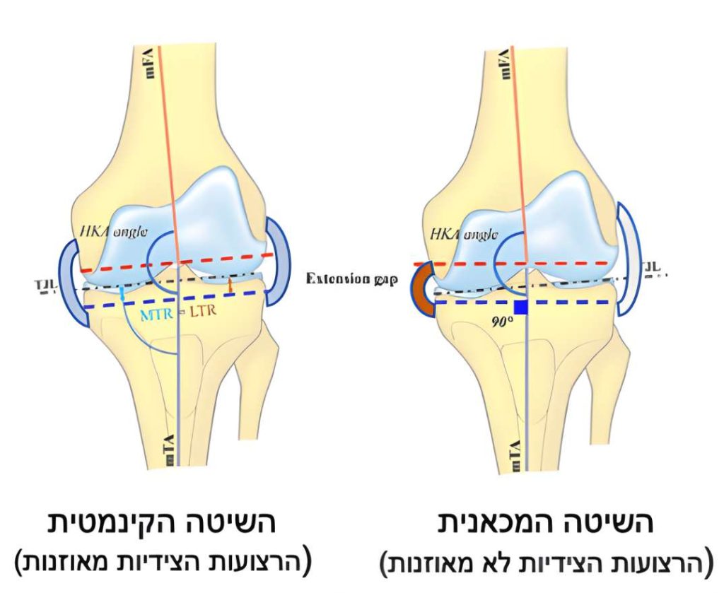 אילוסטרציה של החלפת ברך בשיטה הקינמטית