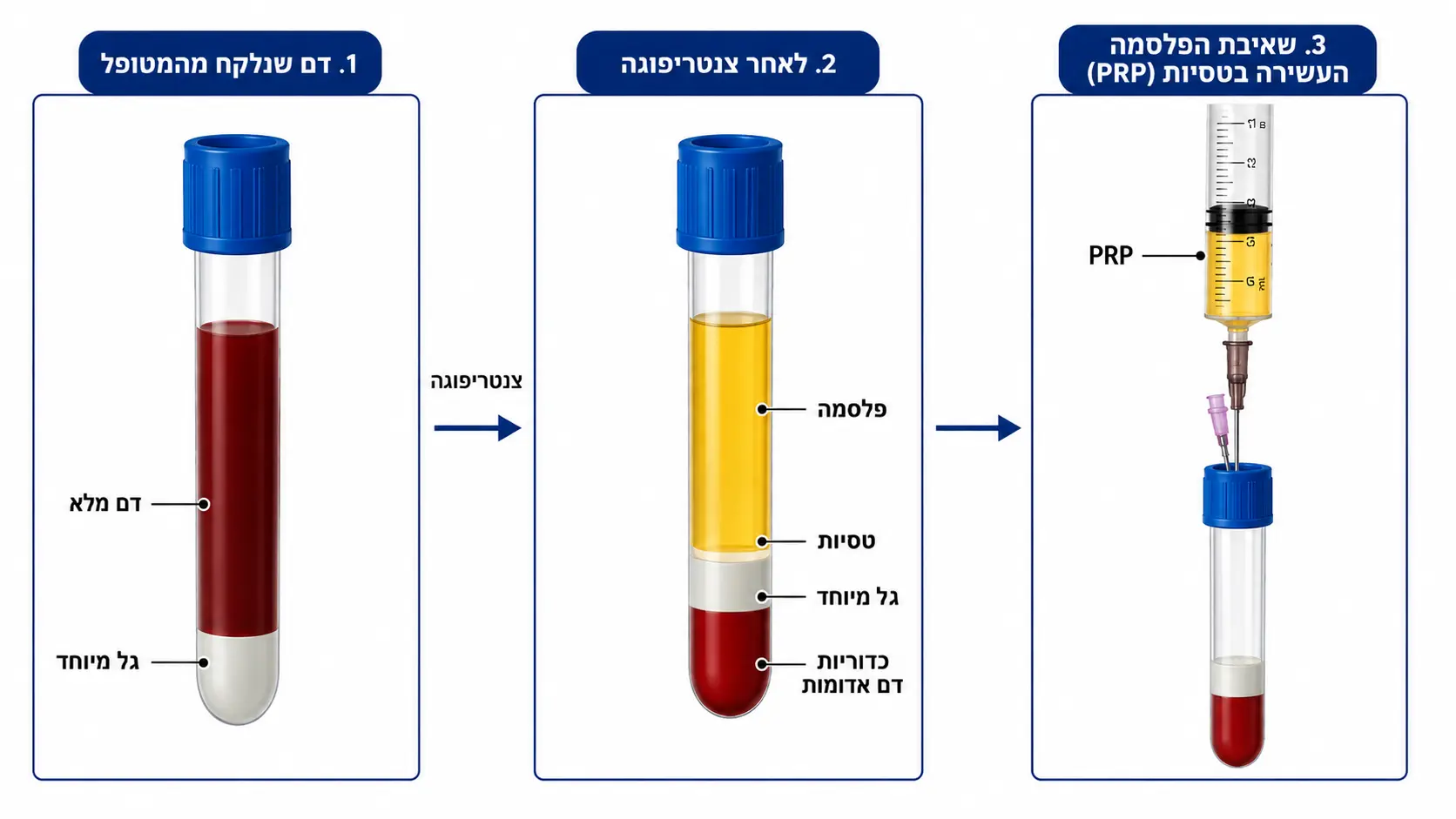 איור רפואי המדגים איך מפיקים את הPRP