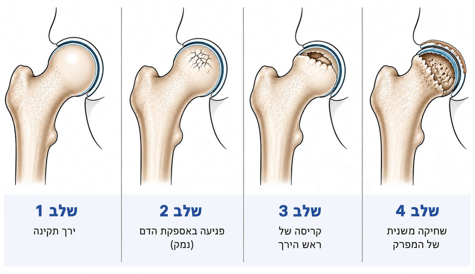 אבחון בשלב מוקדם כדי להבין את מצב המפרק
